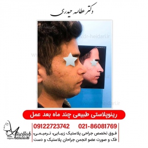 rhinoplasty10
