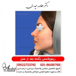 rhinoplasty11