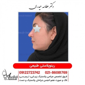 rhinoplasty14