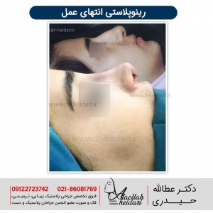 rhinoplasty2