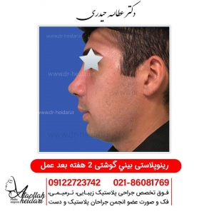 rhinoplasty4