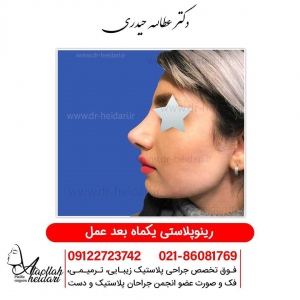 rhinoplasty5