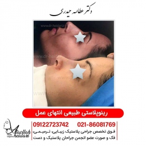 rhinoplasty6