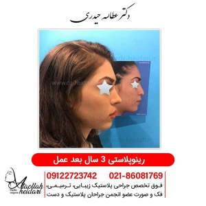 rhinoplasty7