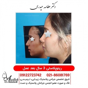 rhinoplasty8