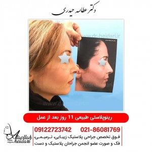 rhinoplasty9