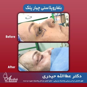 جراحی-پلک-3