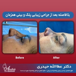 جراحی-پلک-7