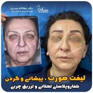 جراحی-پلک23
