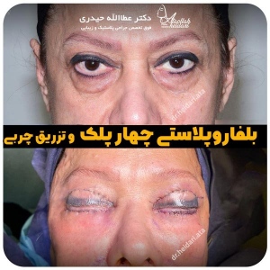 جراحی-پلک25