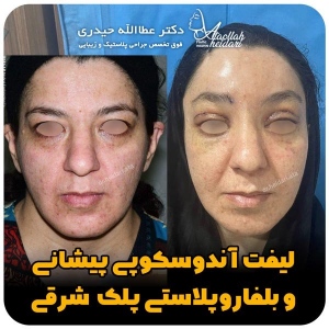 جراحی-پلک28