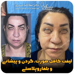جراحی-پلک30