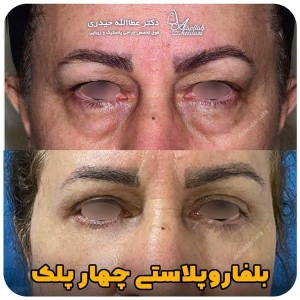 جراحی-پلک35