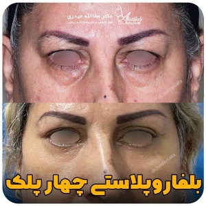 جراحی-پلک38