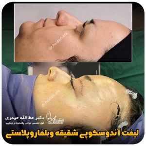 جراحی-پلک42
