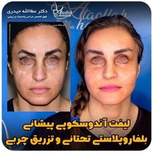 جراحی-پلک43