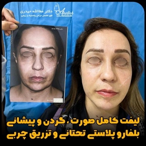جراحی-پلک44