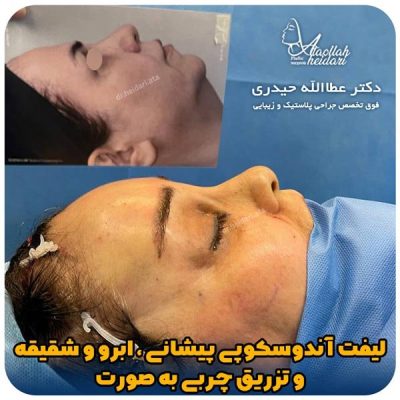 جراحی لیفت ابرو در تهران با دکتر حیدری