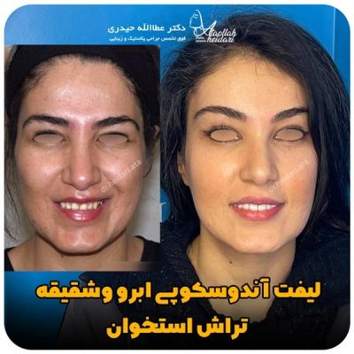 جراحی لیفت ابرو با دکتر حیدری