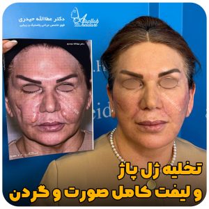 لیفت گردن در تهران - دکتر حیدری
