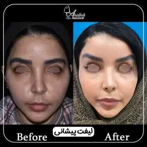 نمونه جراحی های فوق تخصص پلاستیک در تهران _ دکتر عطاالله حیدری