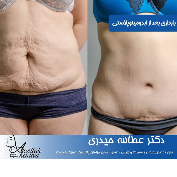 بارداری بعد از ابدومینوپلاستی