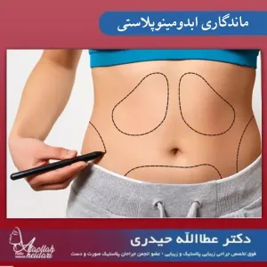 ماندگاری ابدومینوپلاستی _ دکتر عطاالله حیدری