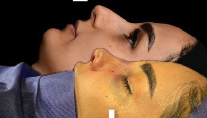 جراحی بینی گوشتی در تهران | هزینه، مدل ها و بهترین جراح