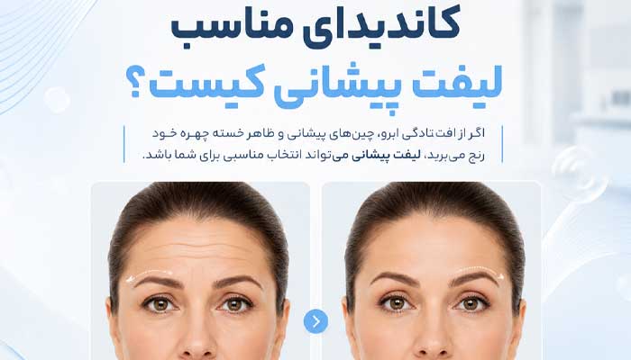 چه کسانی برای لیفت پیشنانی مناسب هستند؟