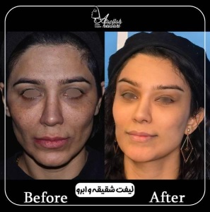1_36.jpg-nggid03130-ngg0dyn-300x300x100-00f0w010c010r110f110r010t010 نمونه کار شقیقه دکتر حیدری