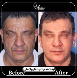 نمونه کار لیفت کامل صورت