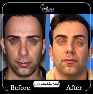 1_43.jpg-nggid03137-ngg0dyn-300x300x100-00f0w010c010r110f110r010t010 نمونه کار لیفت شقیقه در تهران