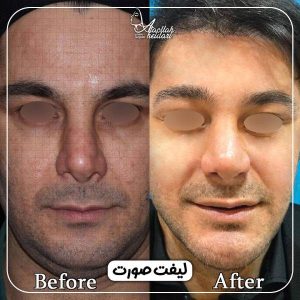 لیفت صورت و گردن