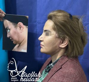 face-lift