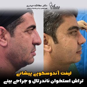 جراحی-لیفت-صورت4