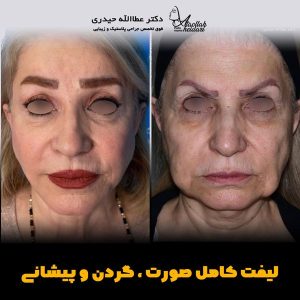 جراحی-لیفت-صورت7 بهترین جراح گردن در تهران