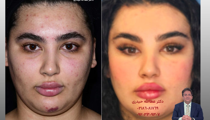 بیهوشی در لیفت صورت؛ عمومی یا موضعی؟ ریسک‌ها